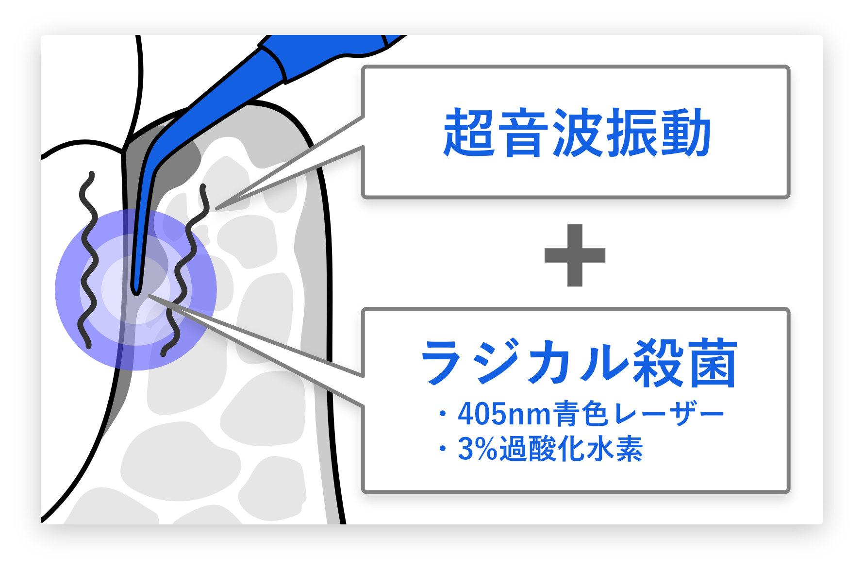 従来の歯周病治療との比較