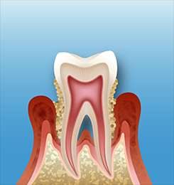 歯周病治療(歯肉炎・歯槽膿漏)